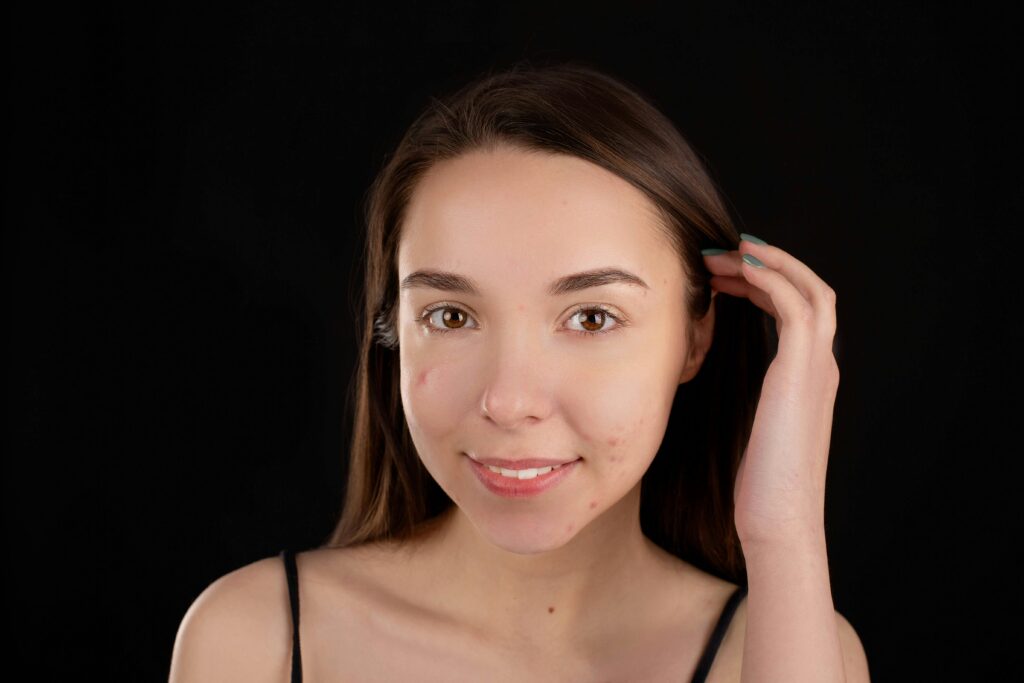 Portrait of a smiling brunette woman with acne on a black background, embracing natural beauty.